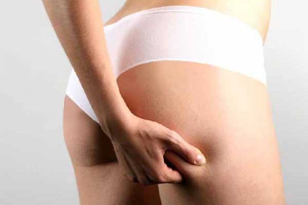 Contrastare la cellulite con metodi naturali e cor