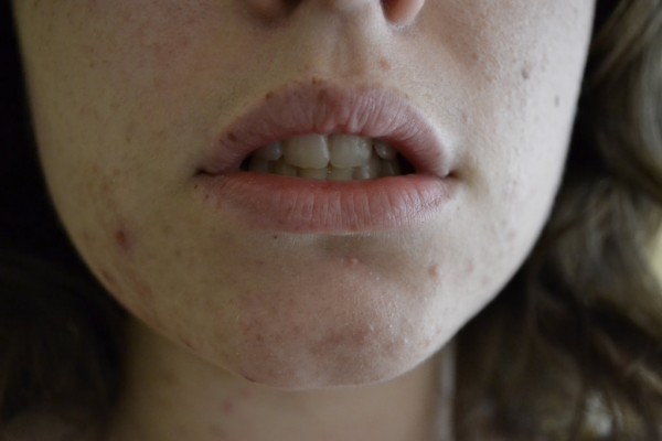 acne rimedi naturali